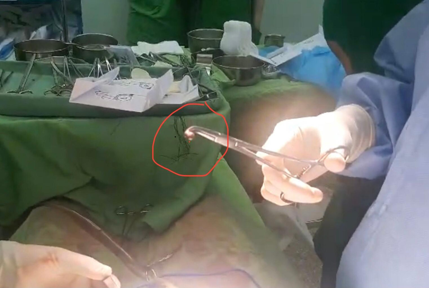 Viên đạn được lấy ra.