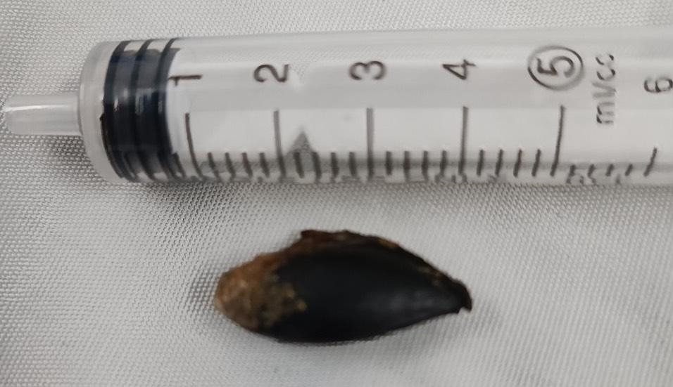 Hạt saboche mắc 26 năm trong phế quản cụ ông đã được lấy ra.