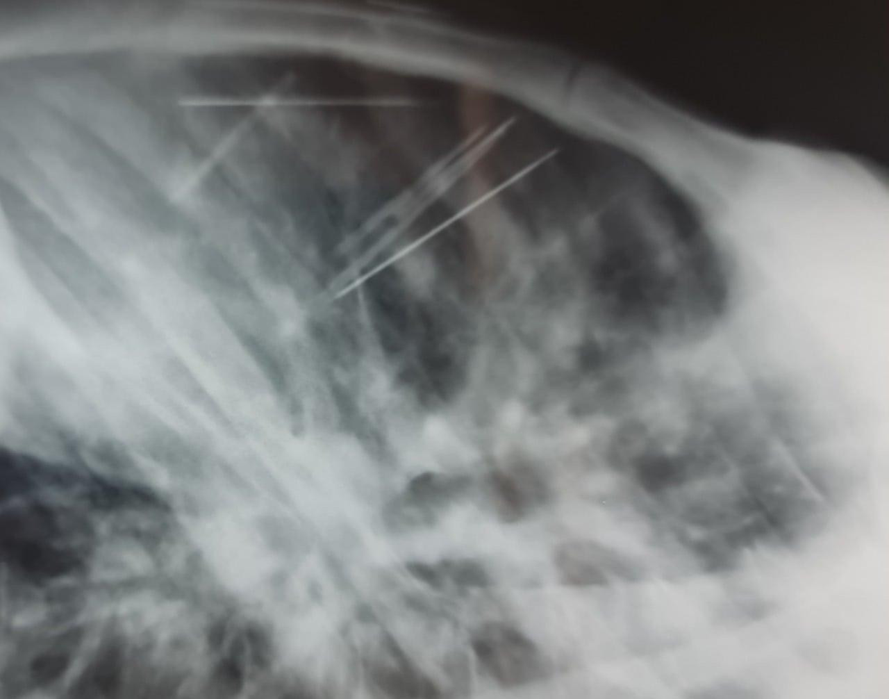 Những chiếc kim bệnh nhân tự đâm vào lồng ngực - Ảnh: Bệnh viện ĐKTPCT. Những chiếc kim bệnh nhân tự đâm vào lồng ngực - Ảnh: Bệnh viện ĐKTPCT.