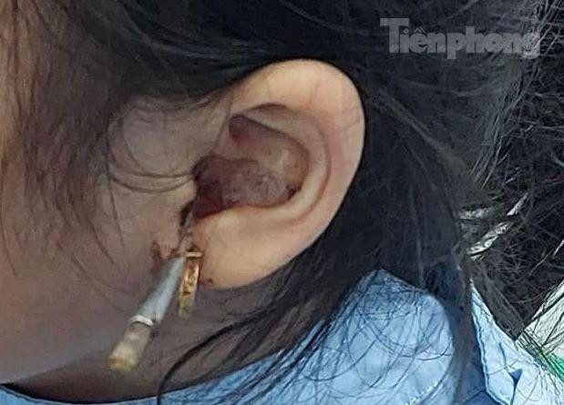 Dị vật xuyên ống tai bé gái thời điểm nhập viện.