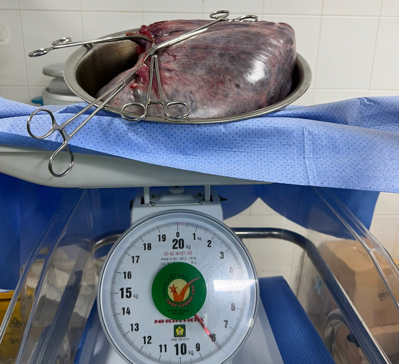 Khối u nang 8kg được lấy ra khỏi cơ thể chị L.