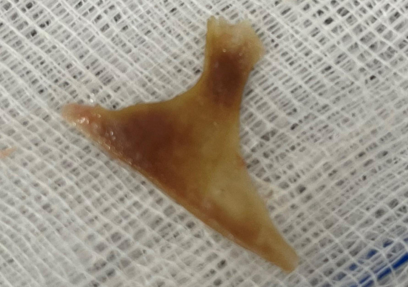 Mảnh xương được lấy ra từ cổ bà T.