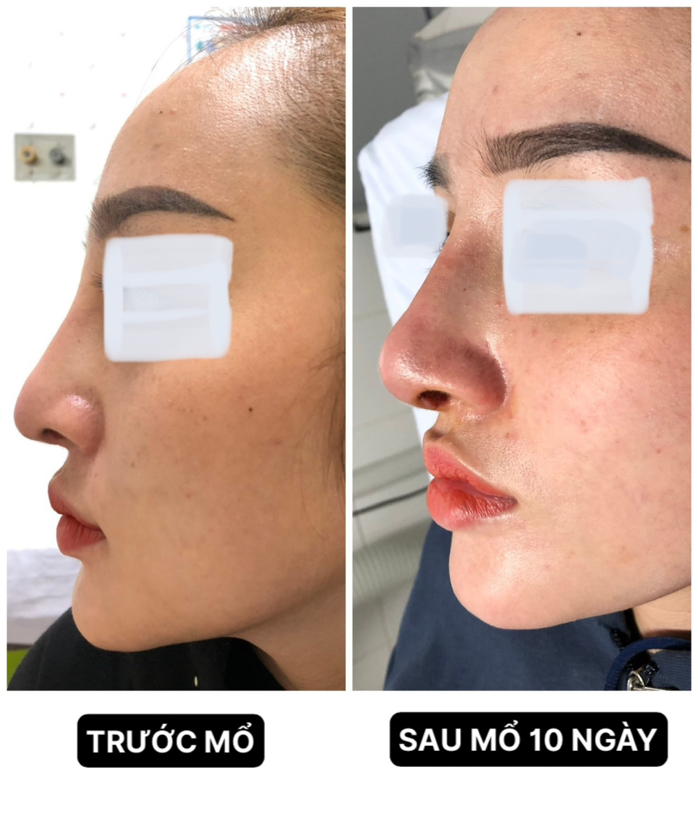 Mũi của chị N. trước và sau mổ. Mũi của chị N. trước và sau mổ.