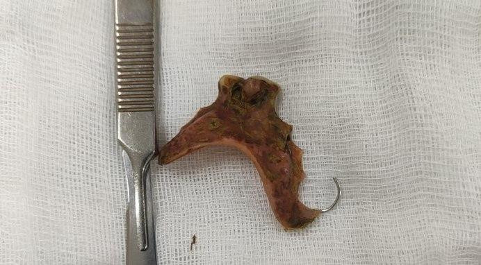 Dị vật gây thủng đại tràng mà bà M. vô tình nuốt trong lúc uống thuốc. Dị vật gây thủng đại tràng mà bà M. vô tình nuốt trong lúc uống thuốc.