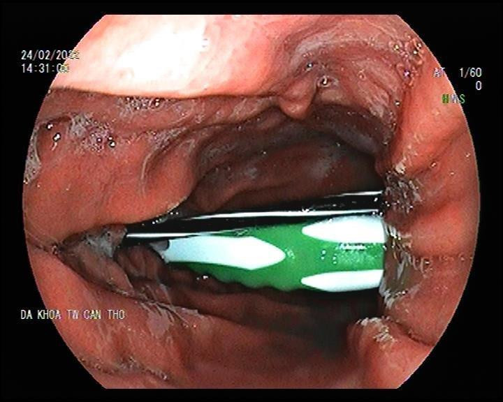 Dị vật được phát hiện trong quá trình nội soi. Dị vật được phát hiện trong quá trình nội soi.