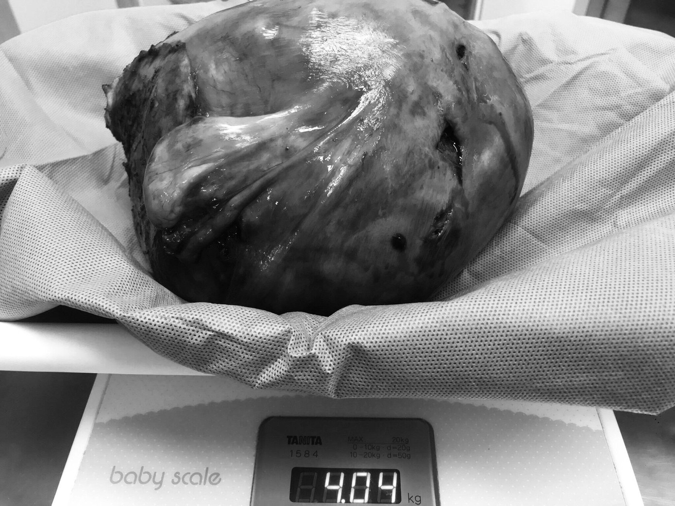 Khối u "khủng" được lấy ra khỏi cơ thể chị P.