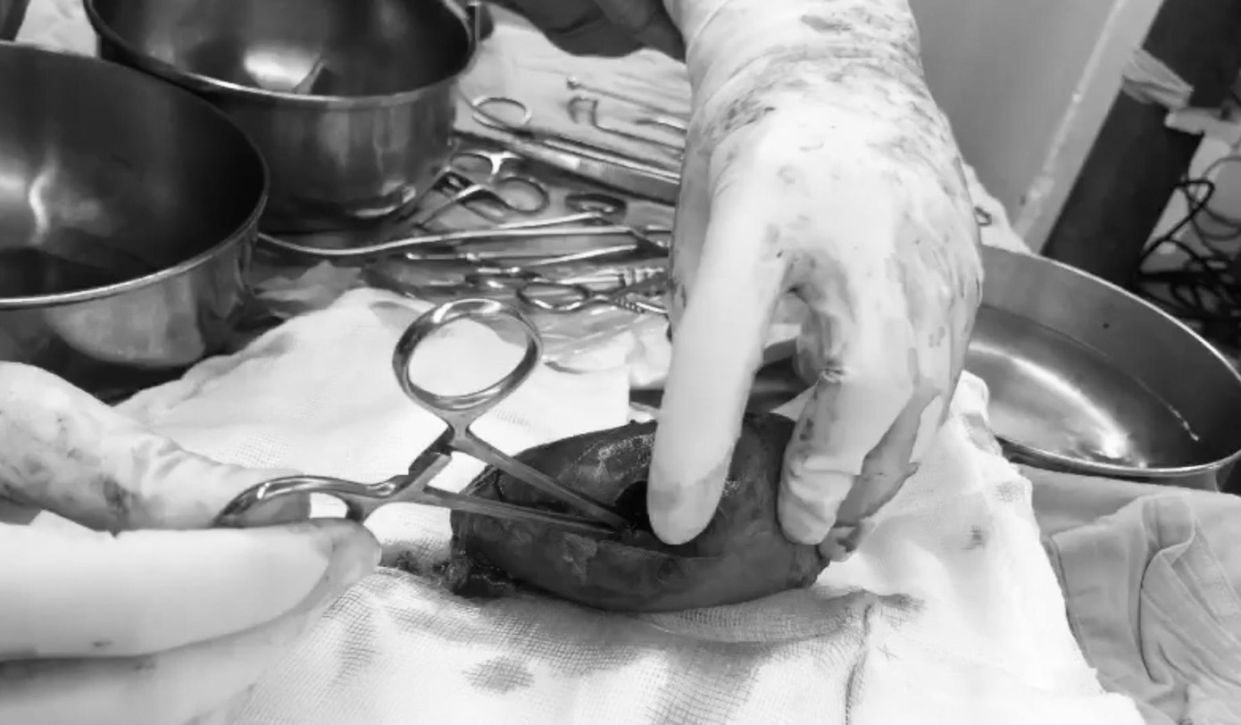 Quả thận bị đạn bắn thủng.