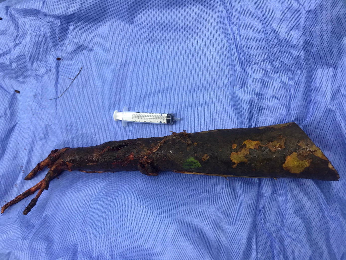 Cọc bần được lấy ra khỏi cơ thể bệnh nhân. Cọc bần được lấy ra khỏi cơ thể bệnh nhân.