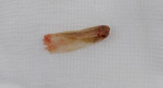 Xương cá mắc 9 tháng trong phế quản nữ bệnh nhân.