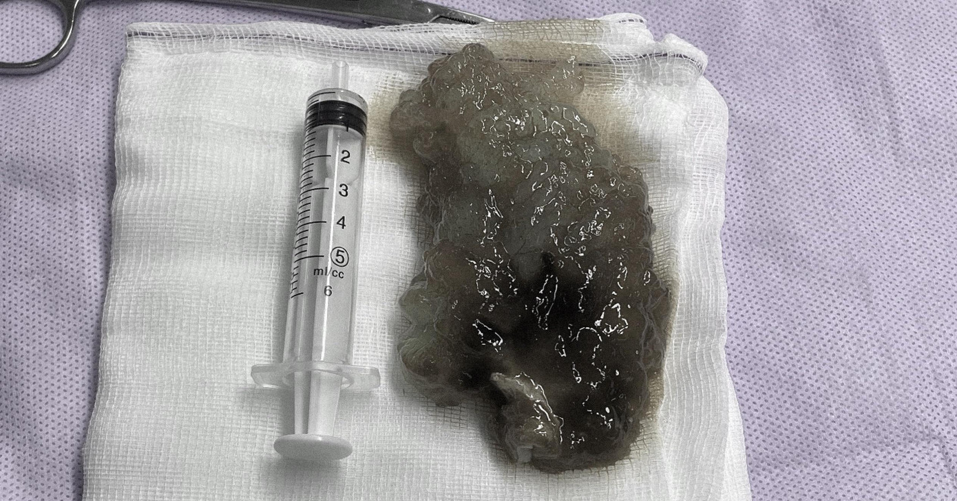 Khối u nhầy "khủng" được lấy ra khỏi cơ thể anh T.