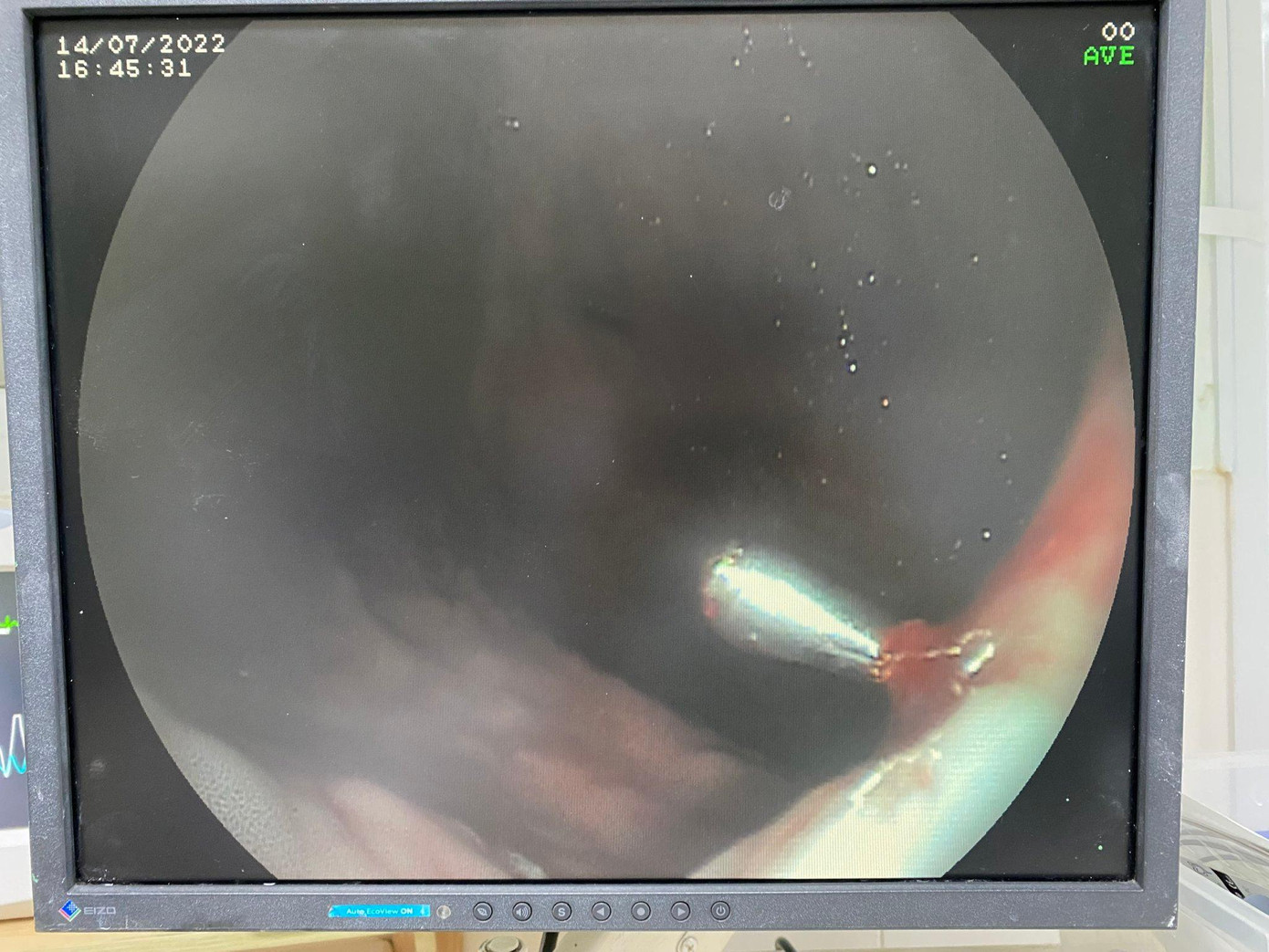 Mảnh thuỷ tinh vỡ cắm vào dạ dày nam bệnh nhân.