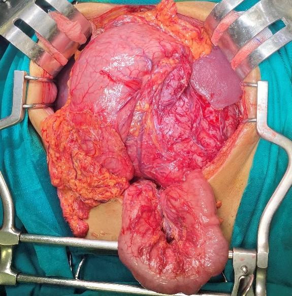 Hình ảnh khối GIST dạ dày xâm lấn thân và đuôi tụy. Ảnh: BS cung cấp Hình ảnh khối GIST dạ dày xâm lấn thân và đuôi tụy. Ảnh: BS cung cấp