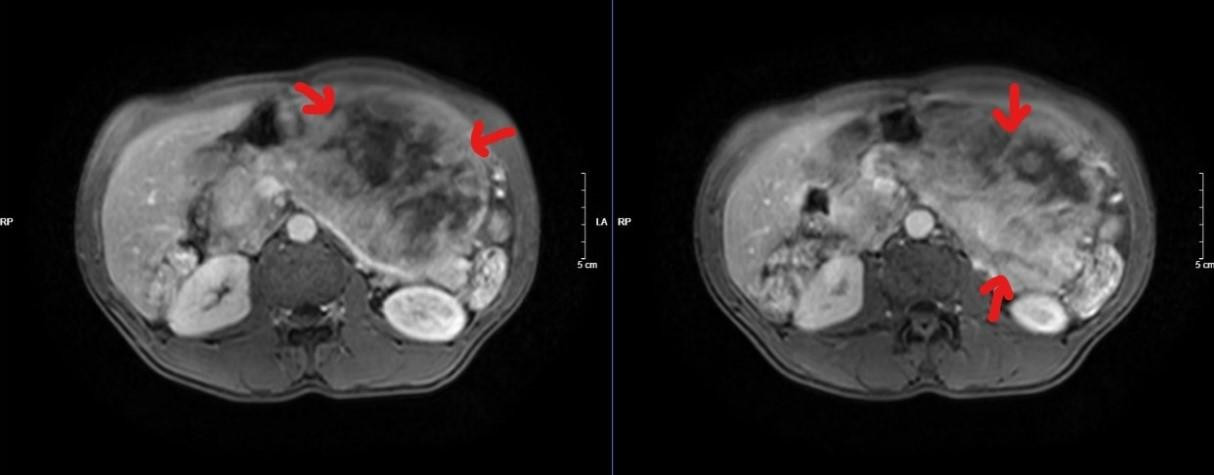 Phim cộng hưởng từ - Hình ảnh khối lớn nửa bụng trái xâm lấn tụy. Ảnh: BS cung cấp Phim cộng hưởng từ - Hình ảnh khối lớn nửa bụng trái xâm lấn tụy. Ảnh: BS cung cấp