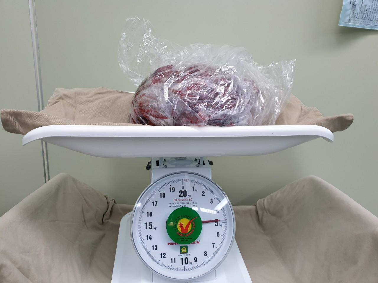 Khối u nặng tới gần 5kg. Ảnh: BS cung cấp Khối u nặng tới gần 5kg. Ảnh: BS cung cấp
