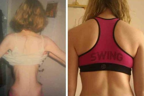 Thời gian Anna gầy ốm nhất do suy dinh dưỡng trầm trọng. Ảnh: Dailyrecord