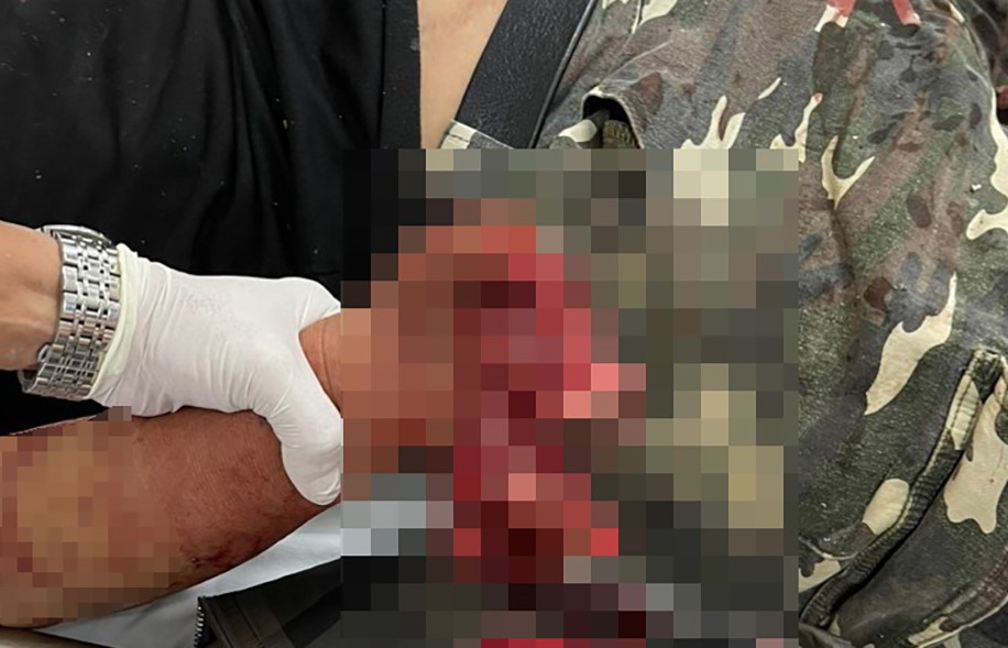 Bàn tay nạn nhân dập nát do pháo nổ