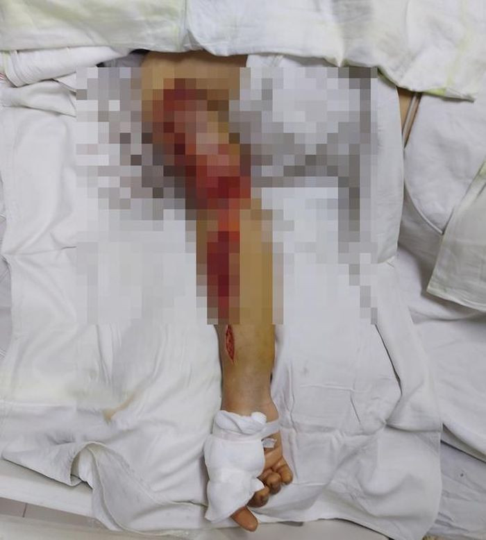 Cánh tay bị đứt rời được các bác sĩ Bệnh viện Hữu nghị Đa khoa Nghệ An nối lại thành công Cánh tay bị đứt rời được các bác sĩ Bệnh viện Hữu nghị Đa khoa Nghệ An nối lại thành công