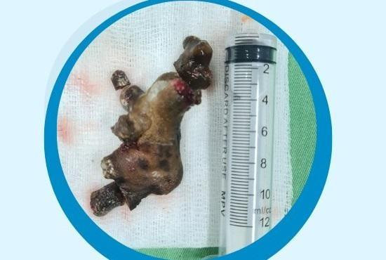 Sỏi thận được lấy ra khỏi thận trái của bệnh nhân Sỏi thận được lấy ra khỏi thận trái của bệnh nhân