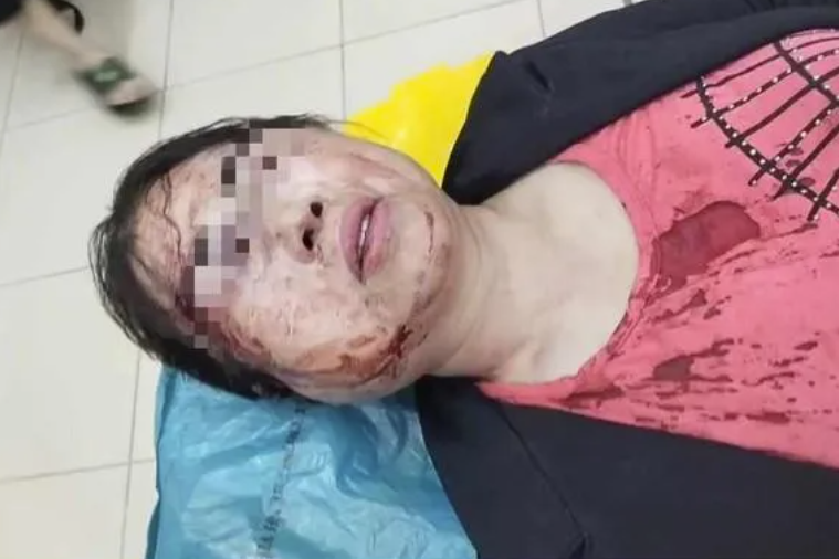 Người phụ nữ bị chồng trẻ hành hung phải nhập viện.