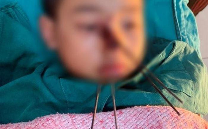 Cháu P. bị 4 mũi tên sắt cắm sâu vào vùng mặt