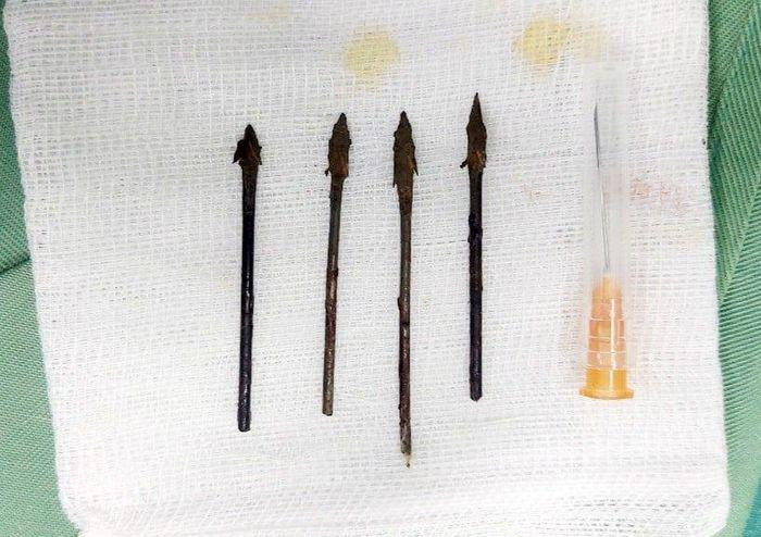 4 đầu mũi tên dài 5 cm được các bác sĩ lấy ra.