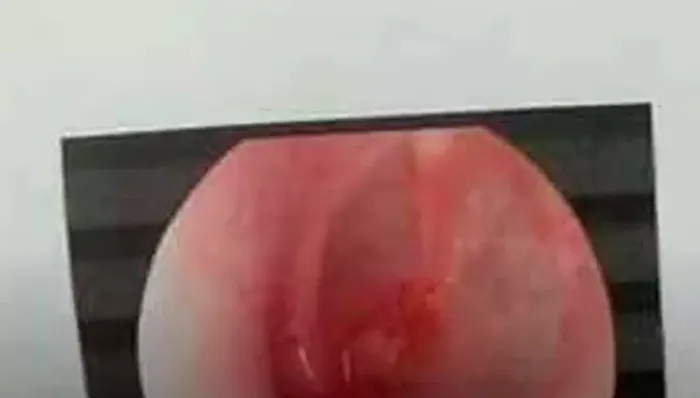 Người thân đăng hình ảnh nam sinh sau khi đi kiểm tra xác định bị rách màng nhĩ Người thân đăng hình ảnh nam sinh sau khi đi kiểm tra xác định bị rách màng nhĩ