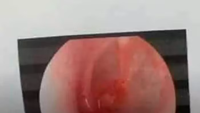 Người thân đăng hình ảnh nam sinh sau khi đi kiểm tra xác định bị rách màng nhĩ Người thân đăng hình ảnh nam sinh sau khi đi kiểm tra xác định bị rách màng nhĩ
