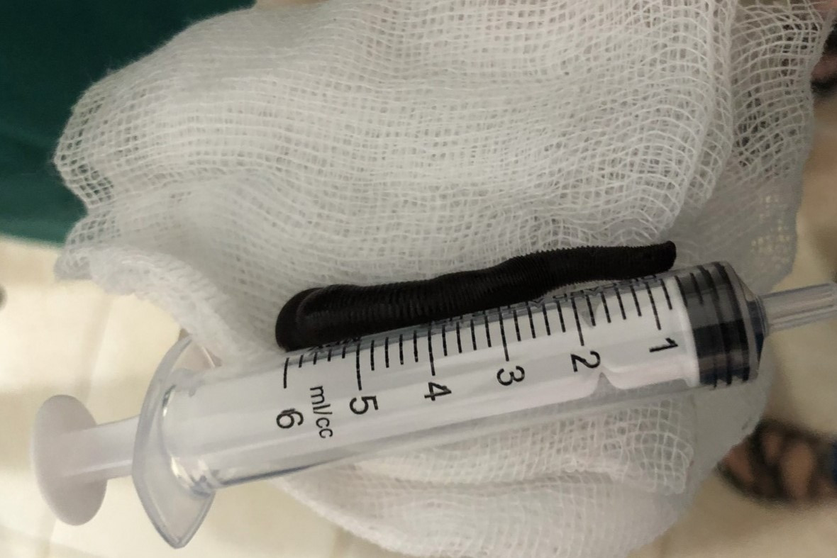 Con đỉa dài 6cm sống trong khí quản người bệnh