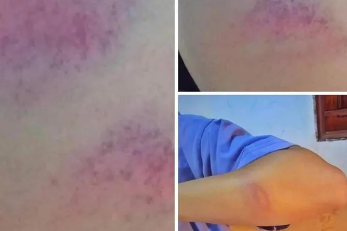 Hình ảnh vết bấm tím trên tay nữ sinh được đăng tải trên mạng xã hội