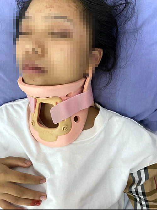 Em N. bị thương nhiều nơi trên cơ thể, hiện đang được điều trị tại bệnh viện