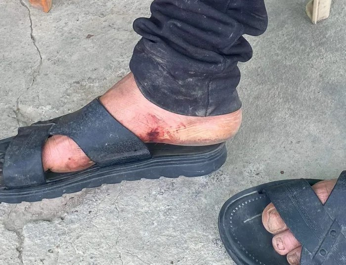 Chân của em Cường rách, chảy máu. Chân của em Cường rách, chảy máu.