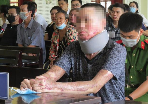 Nạn nhân bị bỏng khắp cơ thể.