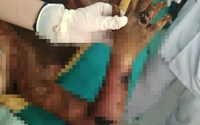 Cháu B. bị nhiễm trùng nặng do đắp thuốc lá chữa bỏng Cháu B. bị nhiễm trùng nặng do đắp thuốc lá chữa bỏng