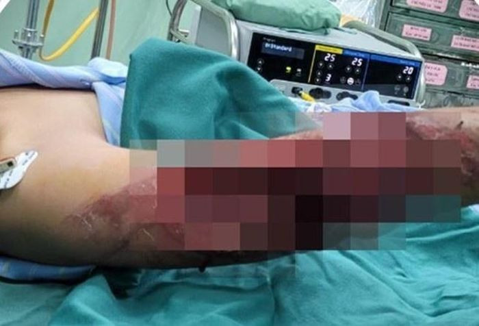 Cánh tay phải bị thương nặng