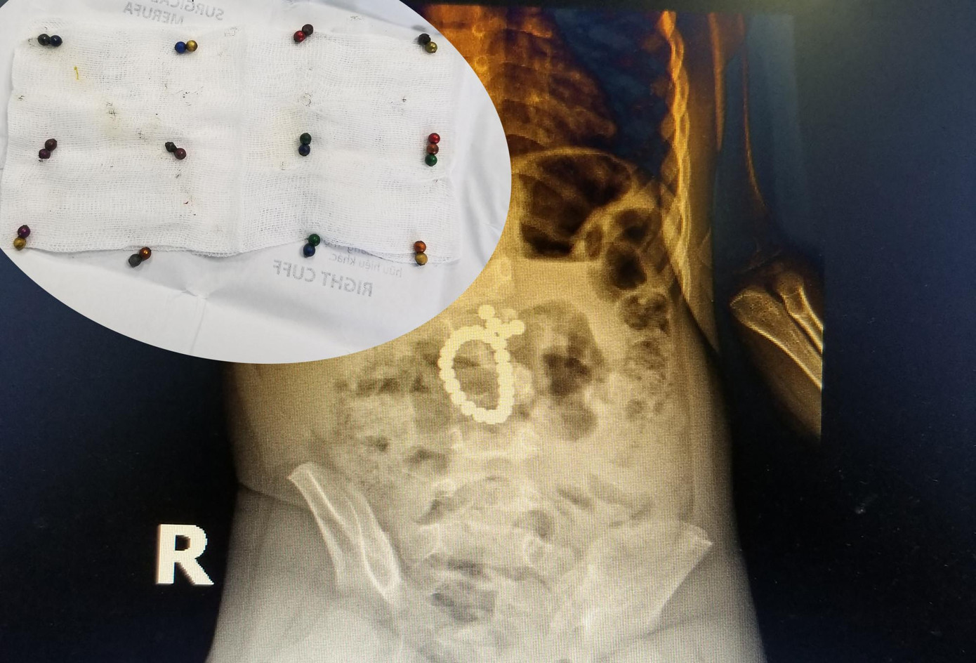 Các viên bi hút vào nhau tạo thành một hình tròn trong ổ bụng (hình lớn) và số viên bi nam châm được lấy ra ngoài (hình nhỏ).