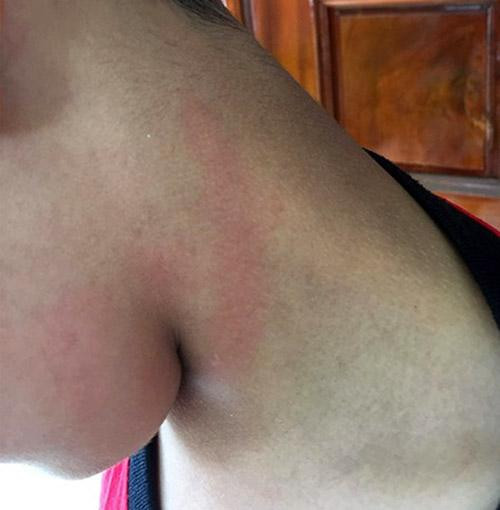 Vết đỏ trên cổ và má em Đ. do bị phụ huynh Kiều tát Vết đỏ trên cổ và má em Đ. do bị phụ huynh Kiều tát