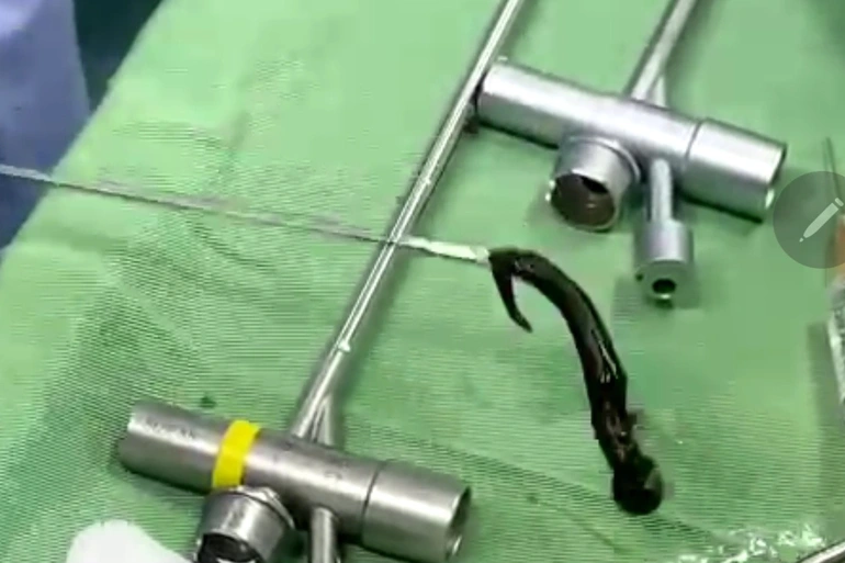 Con vắt được gắp ra từ đường thở của bệnh nhi dài 8cm