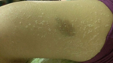 Da bị lột, khắp người loang lổ.