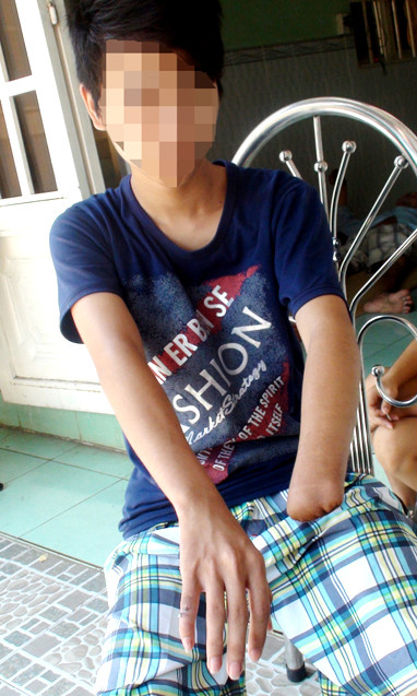 Q. bị mất một bàn tay trong lúc tự chế pháo vào ngày 3-2. Ảnh: N.Khải Q. bị mất một bàn tay trong lúc tự chế pháo vào ngày 3-2