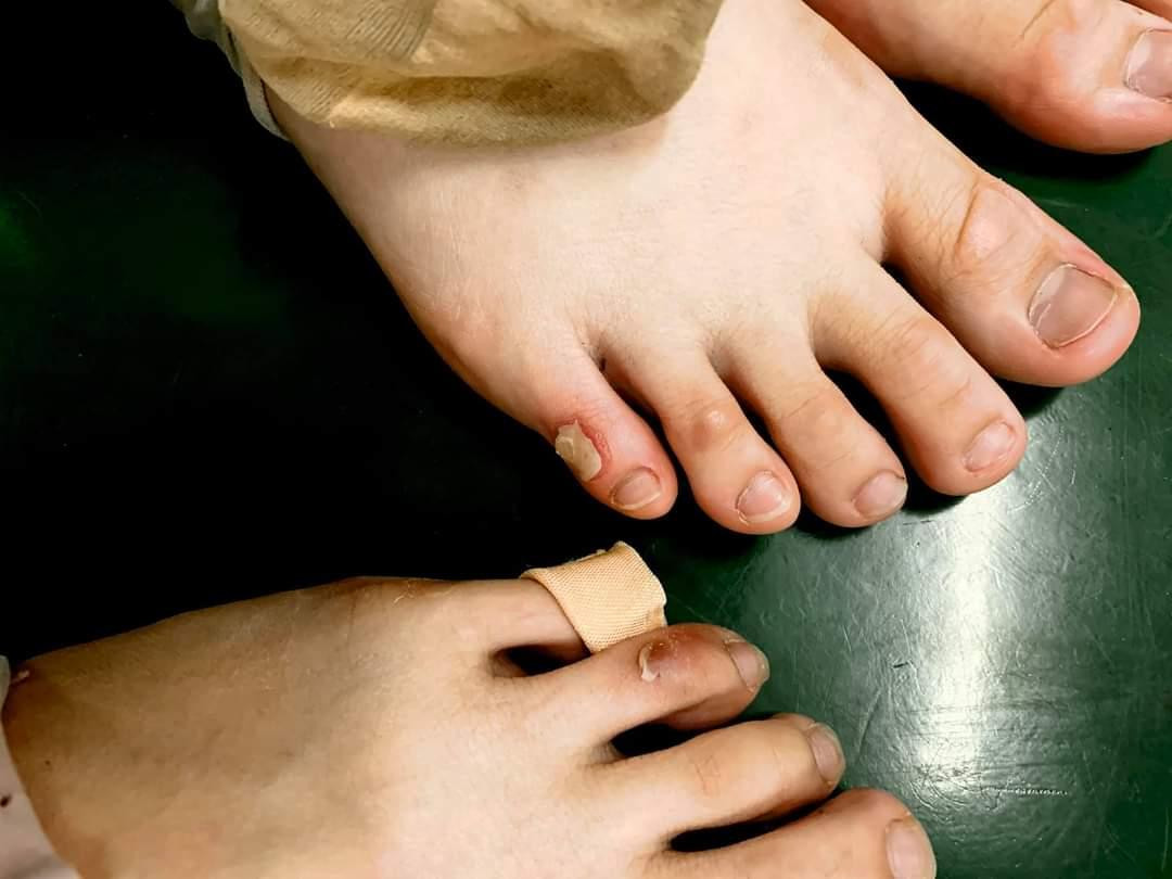 Những đôi chân rớm máu, chai sần vì tập luyện.