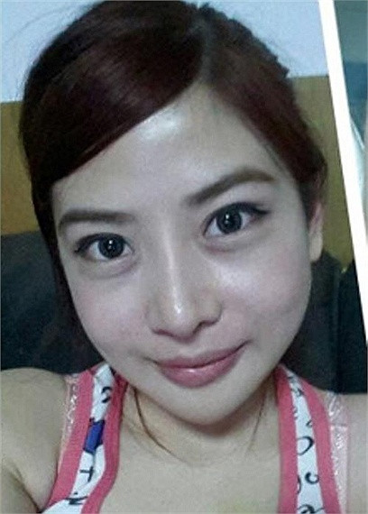 Và đây là hình ảnh của bệnh nhân sau 21 ngày, cô có thể tháo băng trùm đầu, vật dụng được sử dụng để giảm chảy máu và giảm sưng tấy trong thời gian điều trị