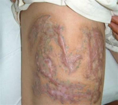 Xăm sẹo hoàn toàn có thể để lại biến chứng, nhiều khi còn nguy hiểm tới cả tính mạng