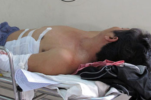 Ông Thạnh (chồng) bị bỏng phần bụng.. Ông Thạnh (chồng) bị bỏng phần bụng.