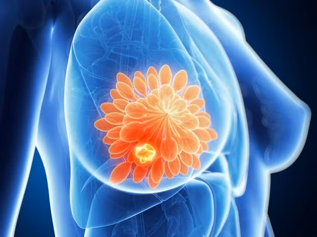 Không phải ai có ngực sần sùi là nguy cơ mắc bệnh ung thư vú cao hơn. Không phải ai có ngực sần sùi là nguy cơ mắc bệnh ung thư vú cao hơn.