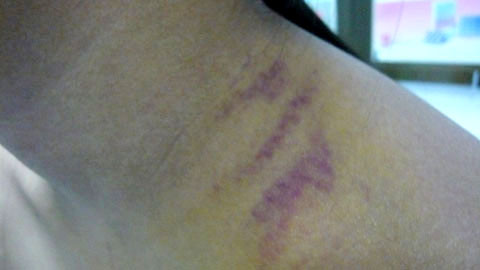 Vết thương do xương gãy vì đeo cặp sách nặng gây bầm tím - Ảnh: Vietnamnet.vn. Vết thương do xương gãy vì đeo cặp sách nặng gây bầm tím - Ảnh: Thanh Huyền.