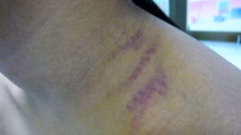 Vết thương do xương gãy vì đeo cặp sách nặng gây bầm tím - Ảnh: Thanh Huyền.