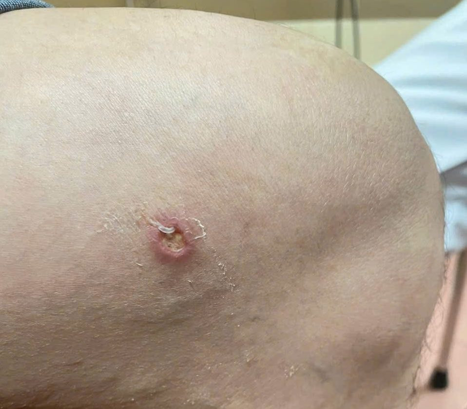 Giun rồng chui ra từ vết thương hở của người đàn ông 47 tuổi. Giun rồng chui ra từ vết thương hở của người đàn ông 47 tuổi.