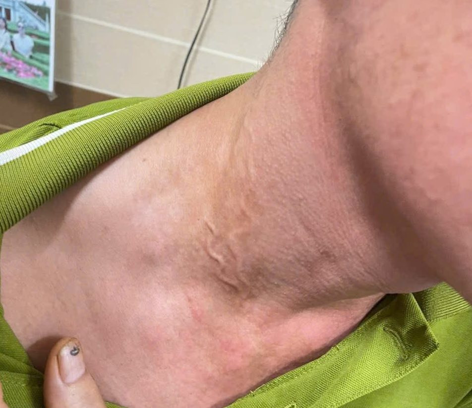 Giun rồng xuất hiện trên cổ người đàn ông 47 tuổi. Giun rồng xuất hiện trên cổ người đàn ông 47 tuổi.