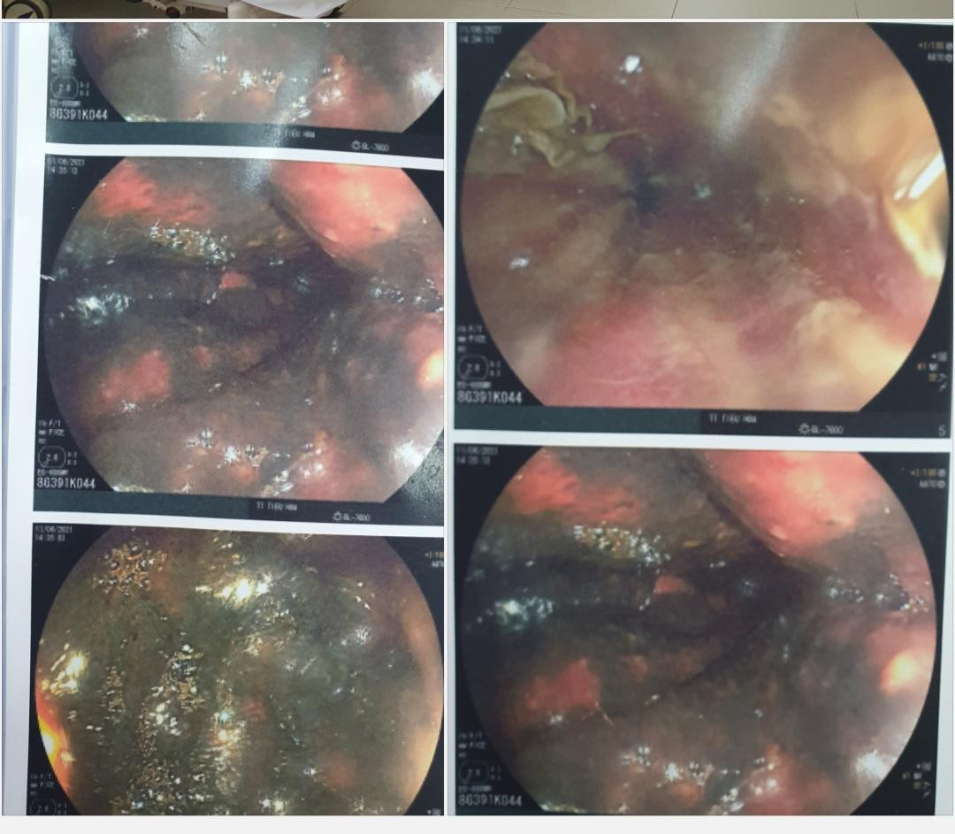 Hình ảnh nội soi đường tiêu hóa của bệnh nhân bị viêm loét phù nề, xung huyết mạnh. Ảnh: Mai ThanhBafi