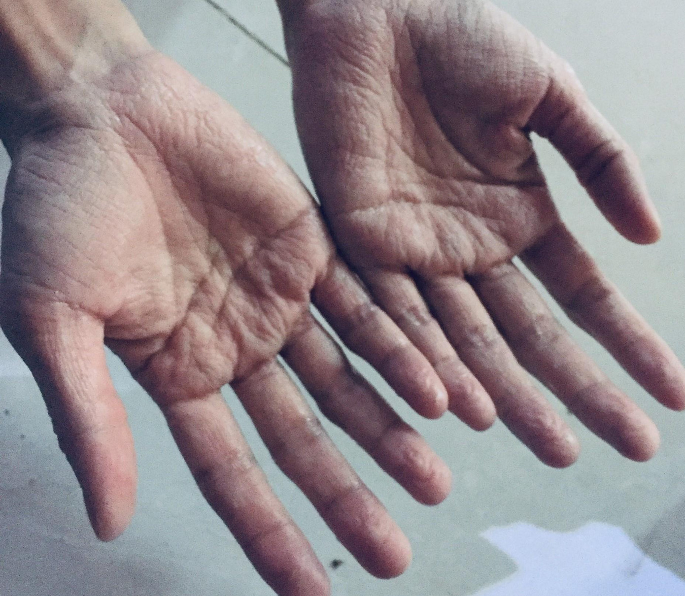 Bàn tay nhăn nheo như vừa được ngâm nước của sinh viên sau khi đeo găng tay y tế quá lâu.